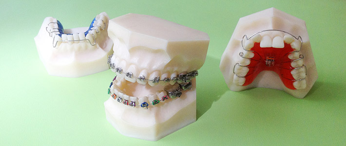 Festsitzende Brackets und herausnehmbare Zahnspangen